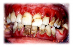 anemia-teeth