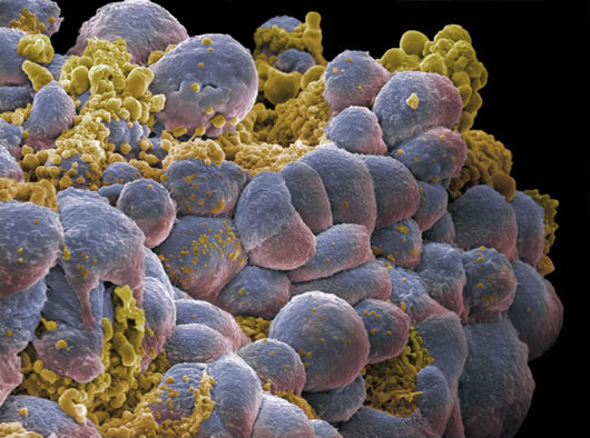 Digital representation of breast cancer cells