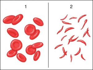 red-blood-cells-normal-n-sickle