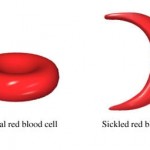 sickle-cell2